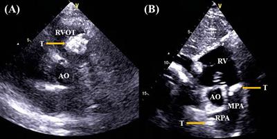 Multiple cardiac myxofibrosarcomas with complete right pulmonary artery occlusion: a case report